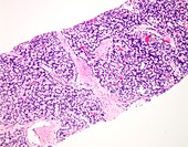 Prostate cancer, light micrograph
