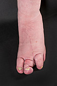 Macrodactyly of the feet