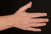 Hidradenitis suppurativa of the thumb