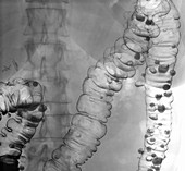 Diverticulosis in large intestine, X-ray