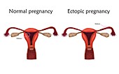 Ectopic pregnancy, illustration