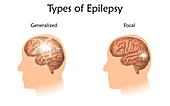 Types of epilepsy, illustration