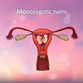 Monozygotic twins, illustration
