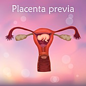 Placenta previa, illustration