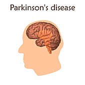 Parkinson's disease, illustration