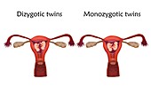 Dizygotic and monozygotic twins, illustration