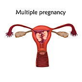 Multiple pregnancy, illustration