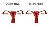 Uterine polyps and uterine fibroid, illustration