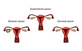 Reproductive system cancers, illustration