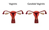 Vaginitis and candidal vaginitis, illustration