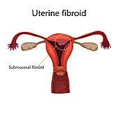Uterine fibroid, illustration