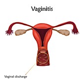 Vaginitis, illustration