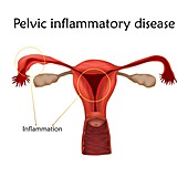 Pelvic inflammatory disease, illustration