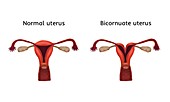 Bicornuate and normal uterus, illustration