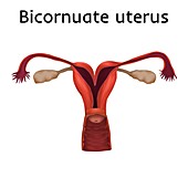 Bicornuate uterus, illustration