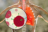 Adenoviral infection of lungs, illustration