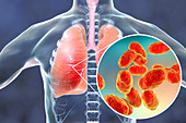 Pneumonia caused by Haemophilus influenzae bacteria, illustr