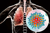 Pneumonia caused by measles viruses, conceptual illustration