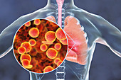Pneumonia caused by Mycoplasma pneumoniae bacteria, conceptu