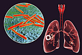 Cavernous pulmonary tuberculosis, illustration