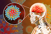 Encephalitis caused by measles viruses, illustration