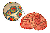 Encephalitis caused by measles viruses, illustration