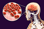 Brain infection caused by Streptococcus pneumoniae bacteria,