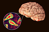 Brain-eating amoeba infection, illustration