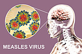 Encephalitis caused by measles viruses, illustration