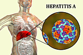 Hepatitis A infection, illustration