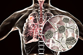 Aspergilloma of the lung, illustration