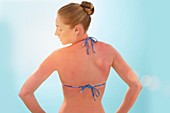Woman with sunburnt back