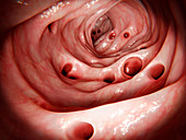 Diverticulosis in large intestine, illustration
