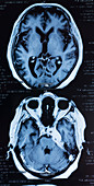 Human brain, MRI scans
