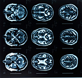 Human brain, MRI scans