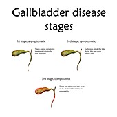 Gallbladder disease stages, illustration