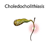 Choledocholithiasis, illustration