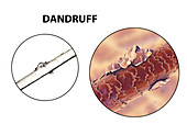 Human hair with dandruff, illustration and micrograph
