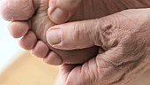 Man with sore dry skin on foot