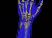 Human wrist bones, rotating 3D CT scan