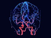 Intracranial and extracranial arteries, rotating 3D CT scan