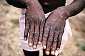 Monkeypox infection, 1997