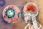 Encephalitis caused by varicella zoster virus, illustration