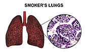Smoker's lungs, illustration and light micrograph