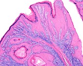 Papilloma, light micrograph