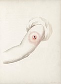 Cowpox, illustration from Edward Jenner's book