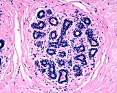 Breast sclerosis, light micrograph