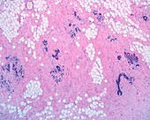 Breast fibrosis, light micrograph