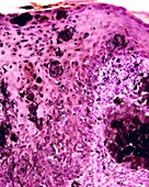 Intradermal pigmented nevus, light micrograph
