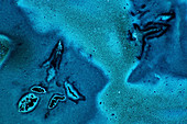 Hyaluronic acid, polarised light micrograph
